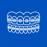 Self Ligating Brackets Icon Blue