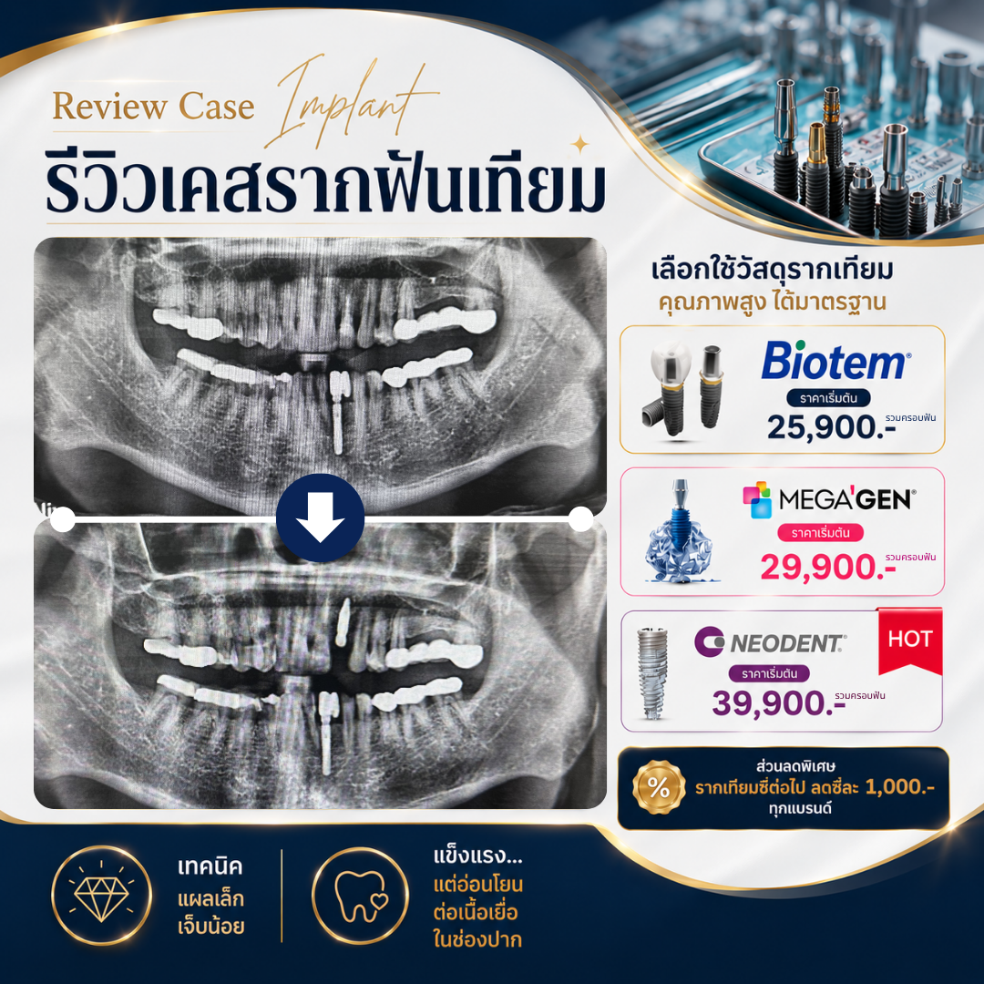 Immediate Implant Case