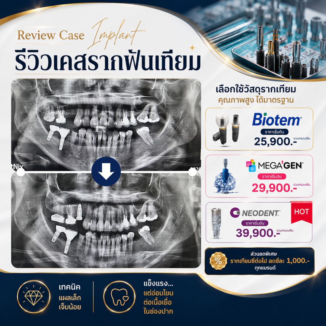 Anterior Implant Case
