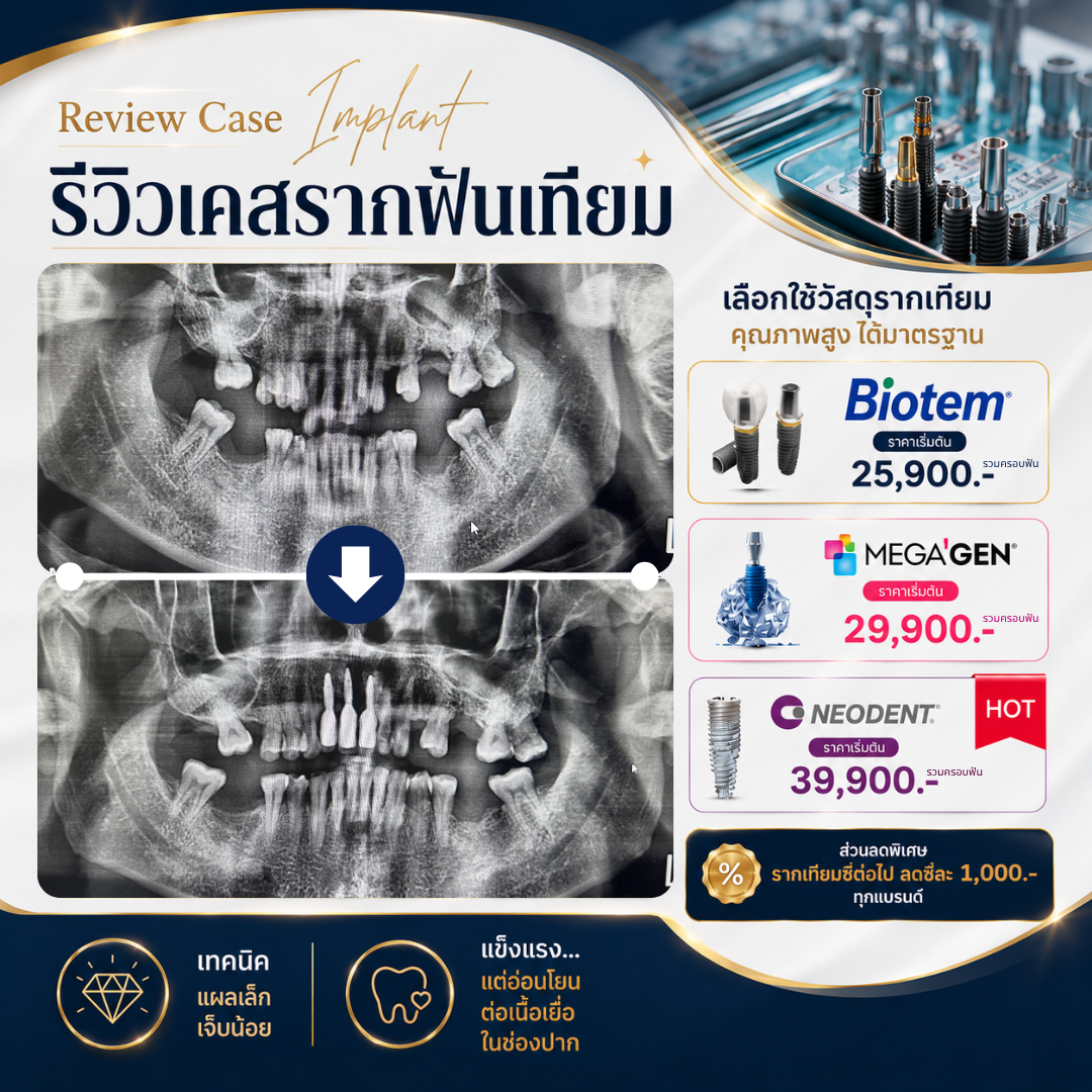 Posterior Implant Case