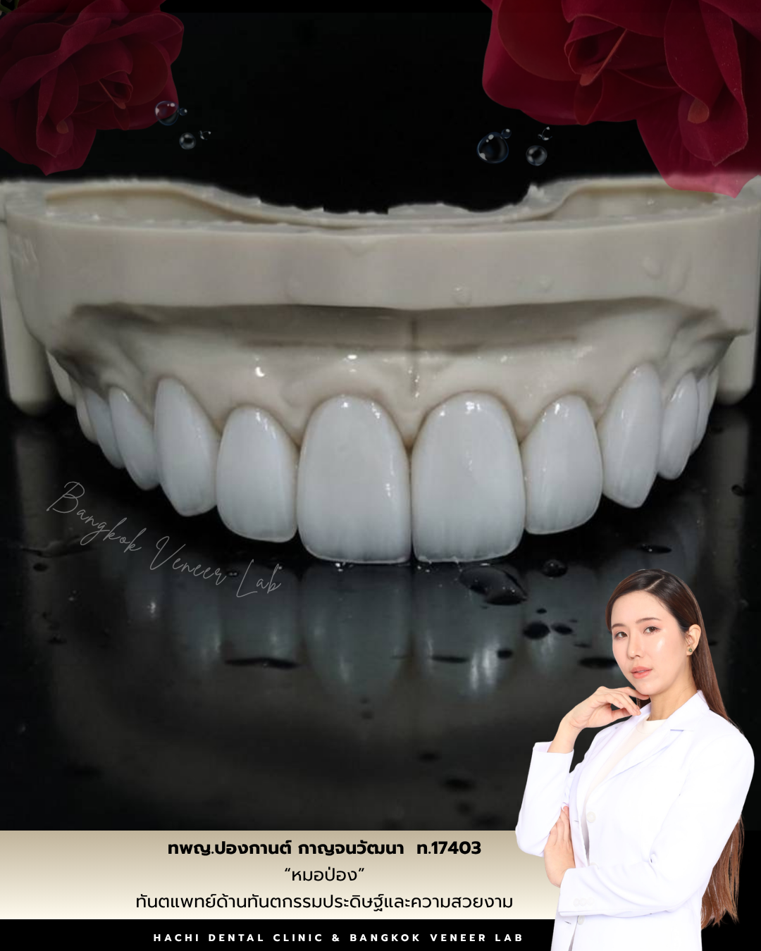 ผลงานวีเนียร์เซรามิก Hachi Dental 6