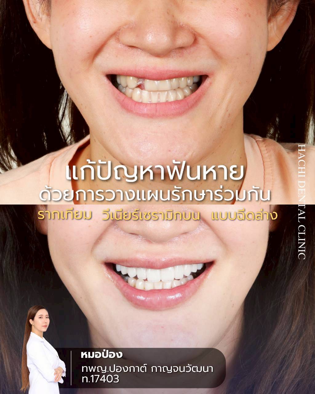รีวิวเคสวีเนียร์เซรามิก Hachi Dental ภาพ 1