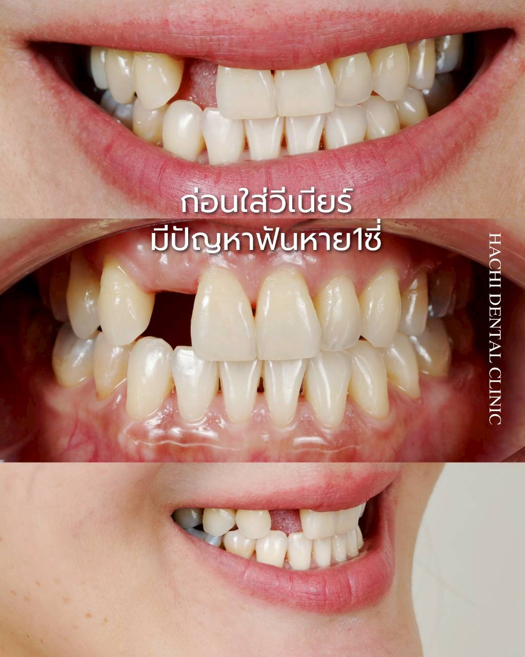 ผลงานวีเนียร์เซรามิก Hachi Dental 15