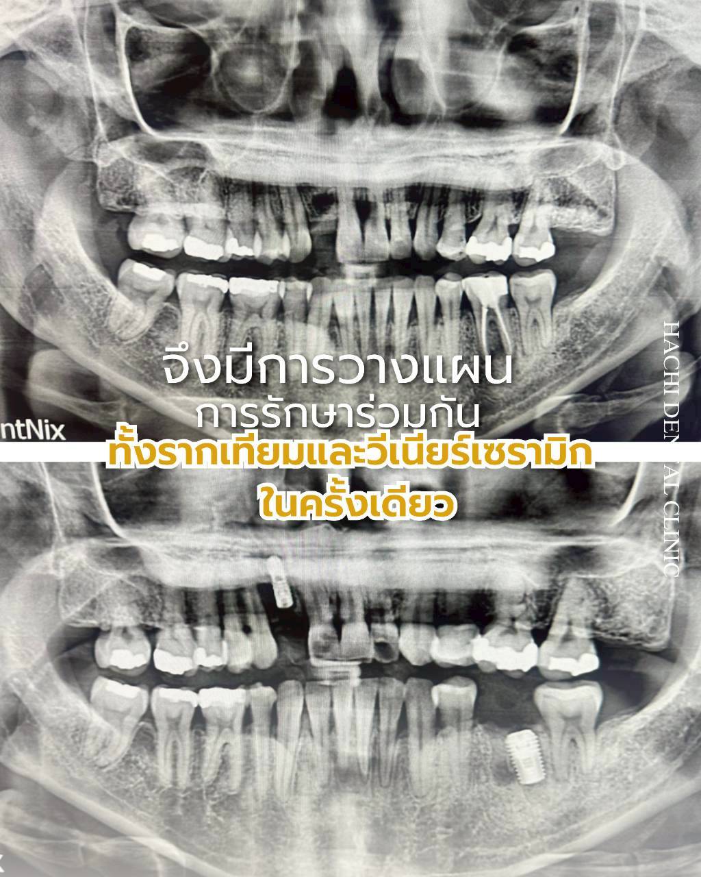 ผลงานวีเนียร์เซรามิก Hachi Dental 16