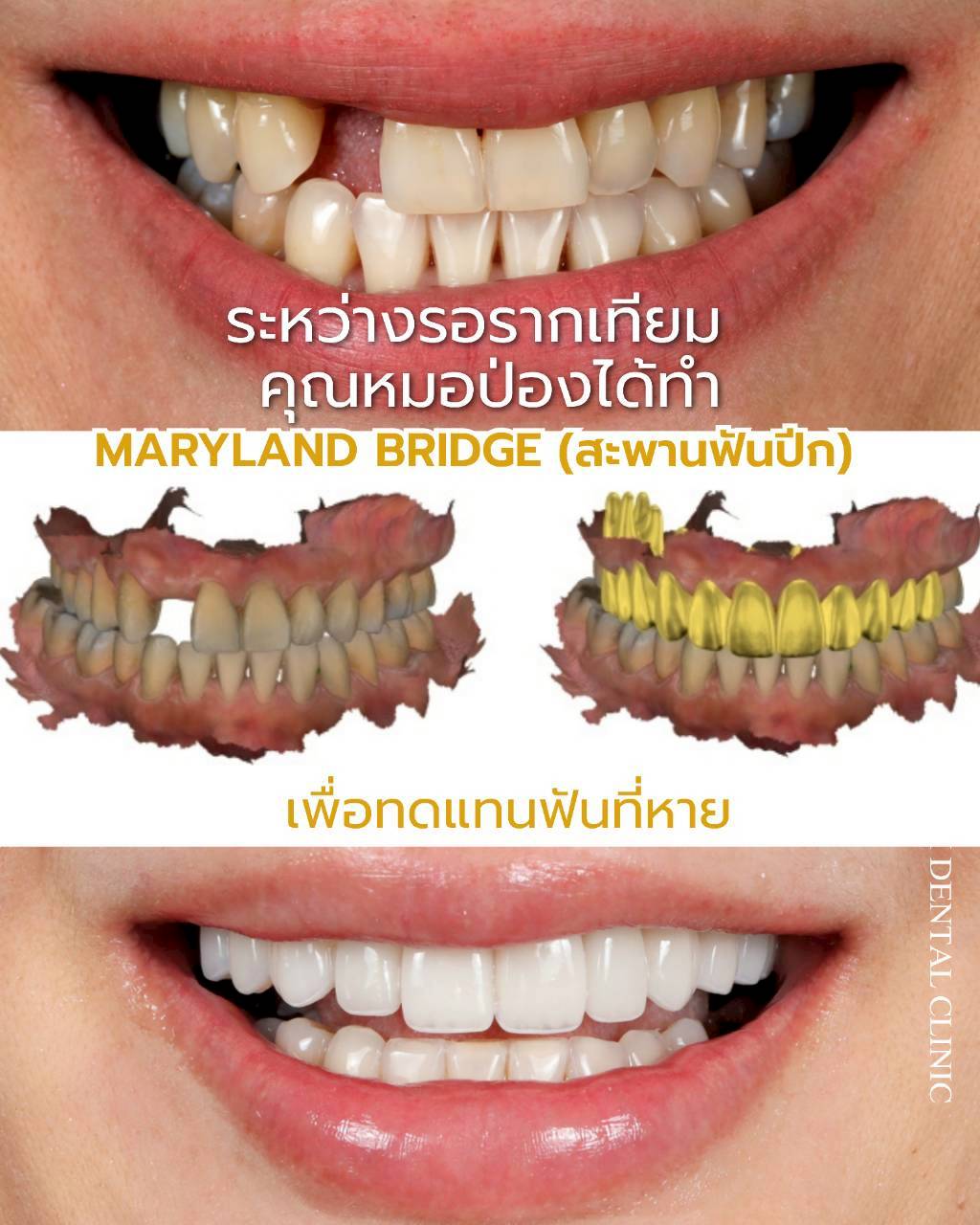 รีวิวเคสวีเนียร์เซรามิก Hachi Dental ภาพ 4