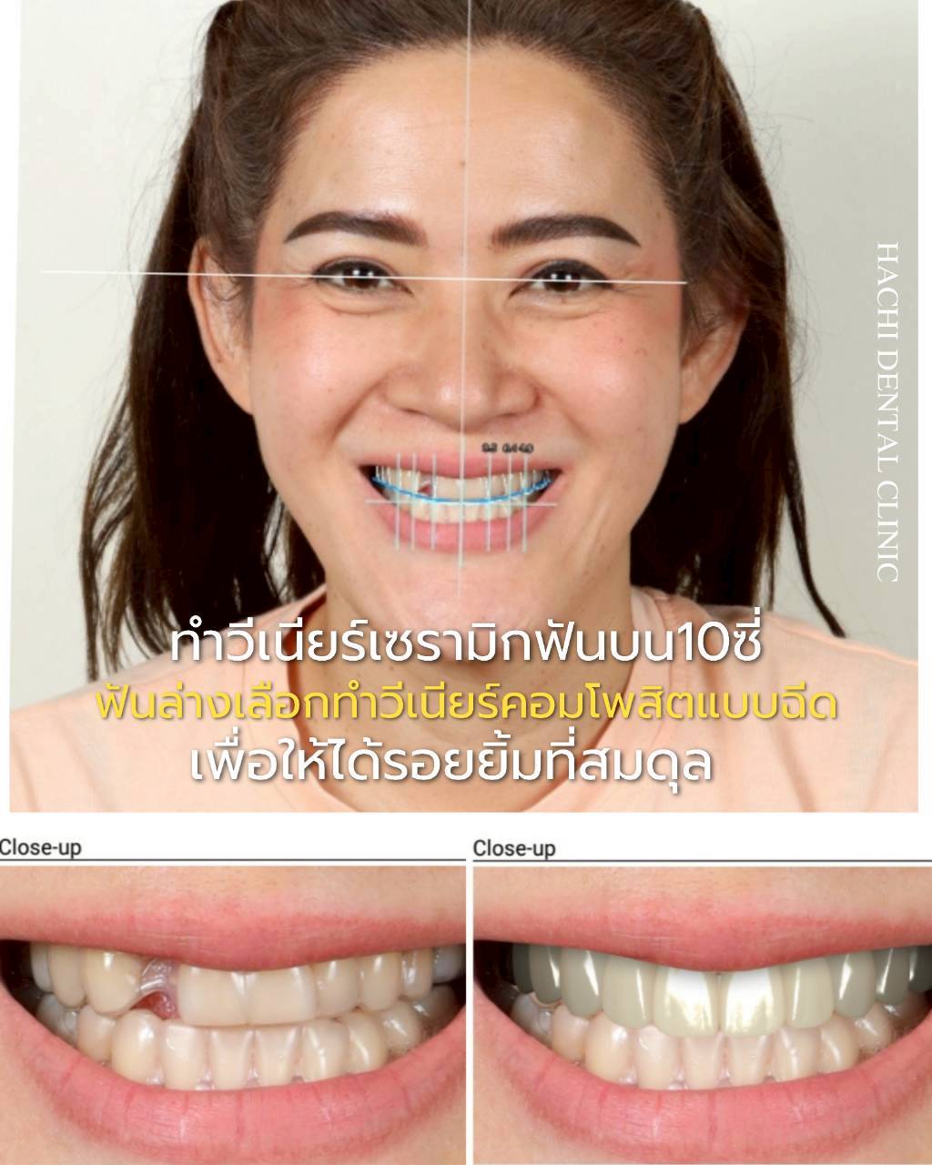 รีวิวเคสวีเนียร์เซรามิก Hachi Dental ภาพ 5