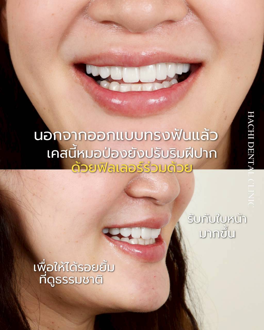 รีวิวเคสวีเนียร์เซรามิก Hachi Dental ภาพ 6
