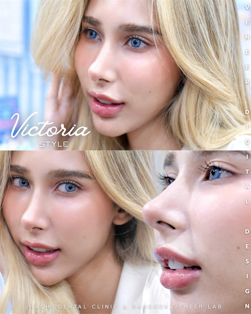 รีวิววีเนียร์เซรามิก Hachi Dental ภาพ 220