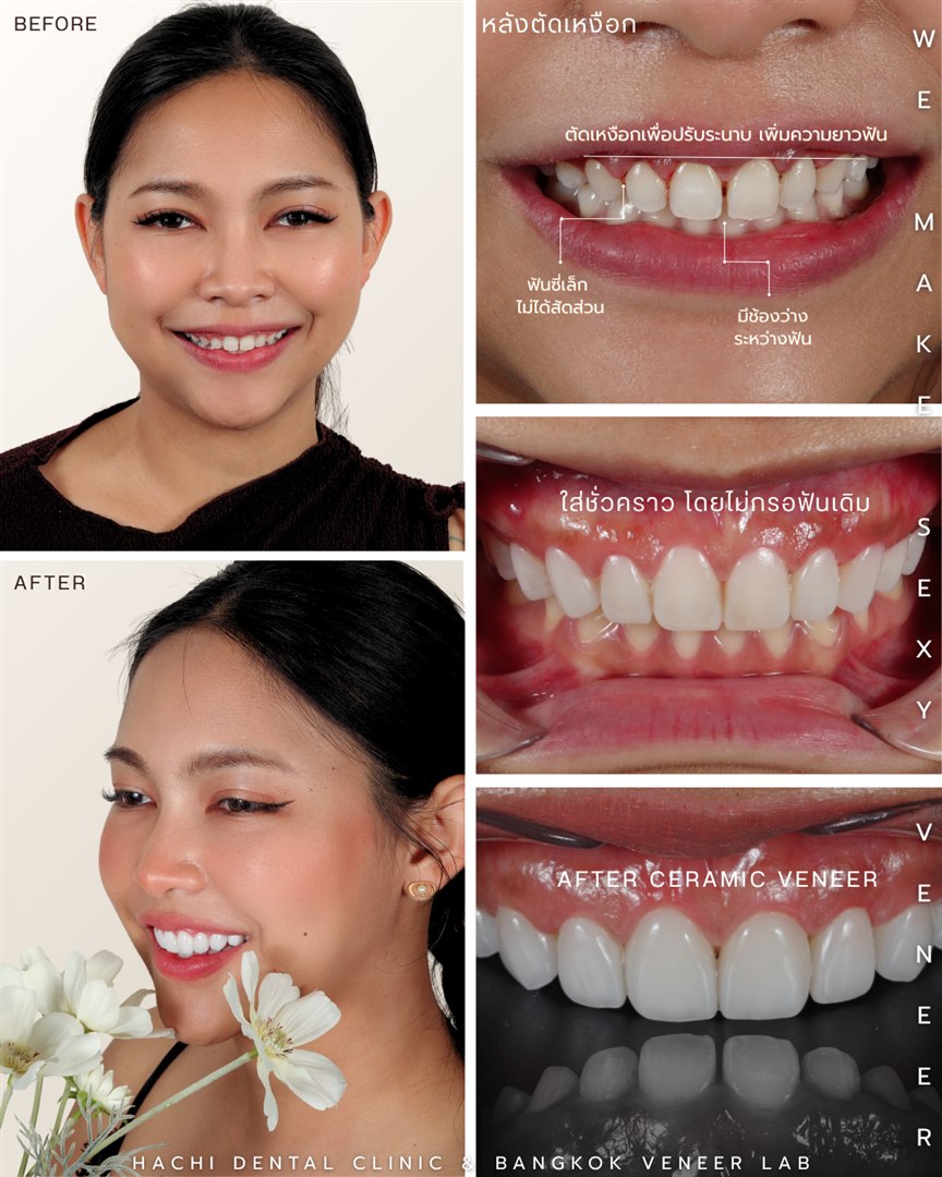 รีวิววีเนียร์เซรามิก Hachi Dental ภาพ 336