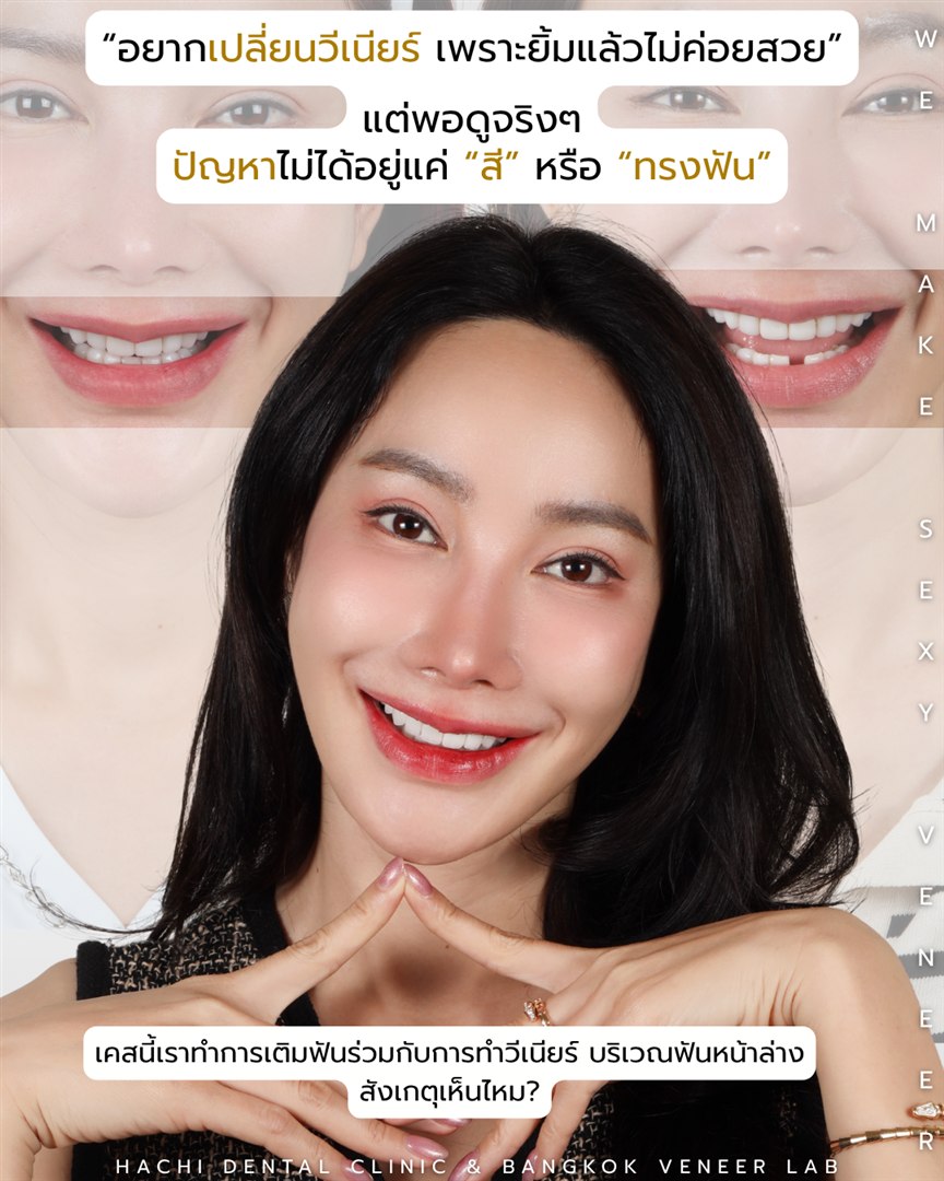 รีวิววีเนียร์เซรามิก Hachi Dental ภาพ 374