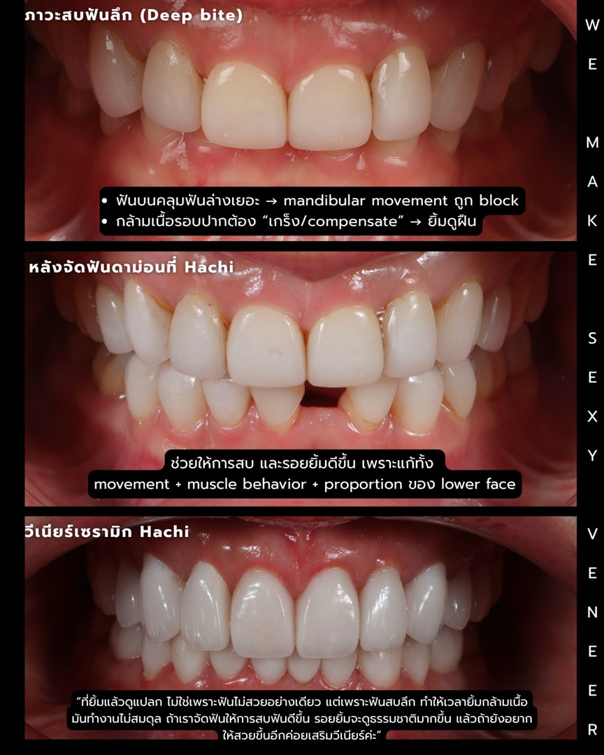 รีวิววีเนียร์เซรามิก Hachi Dental ภาพ 375