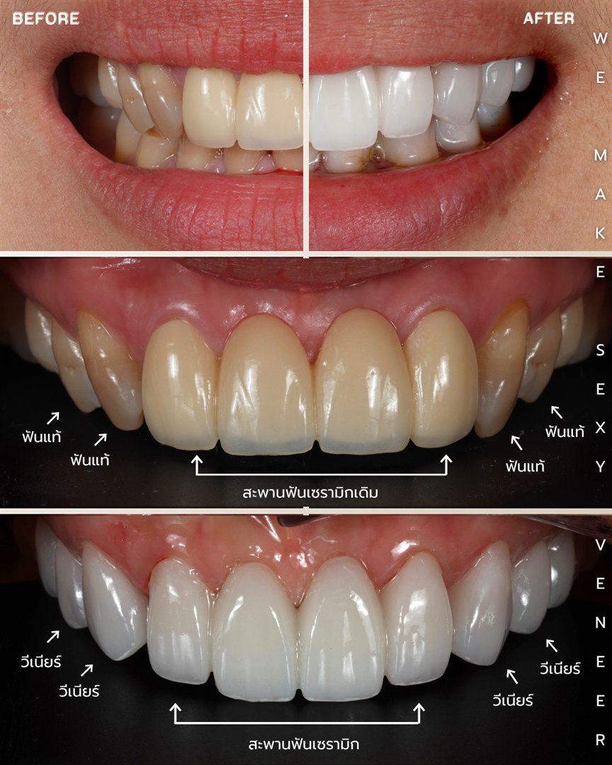 รีวิววีเนียร์เซรามิก Hachi Dental ภาพ 389