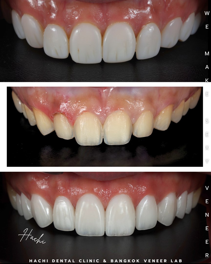 รีวิววีเนียร์เซรามิก Hachi Dental ภาพ 400
