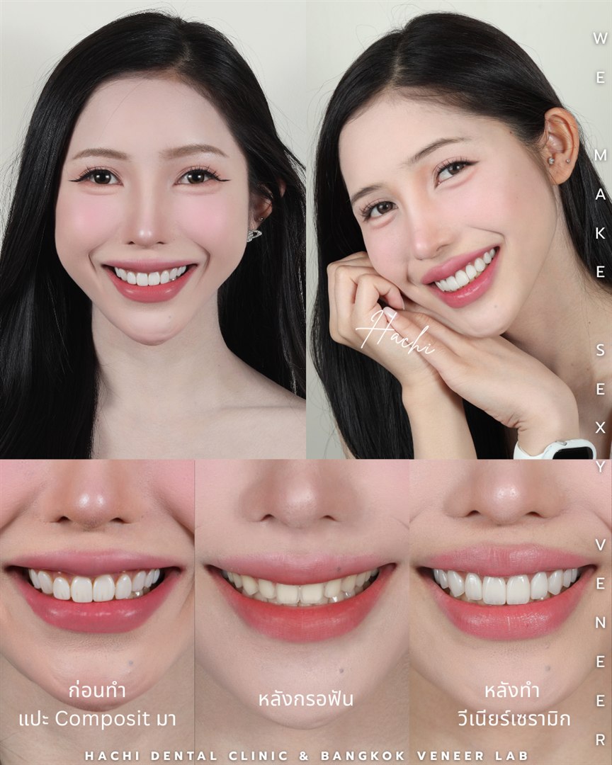 รีวิววีเนียร์เซรามิก Hachi Dental ภาพ 401