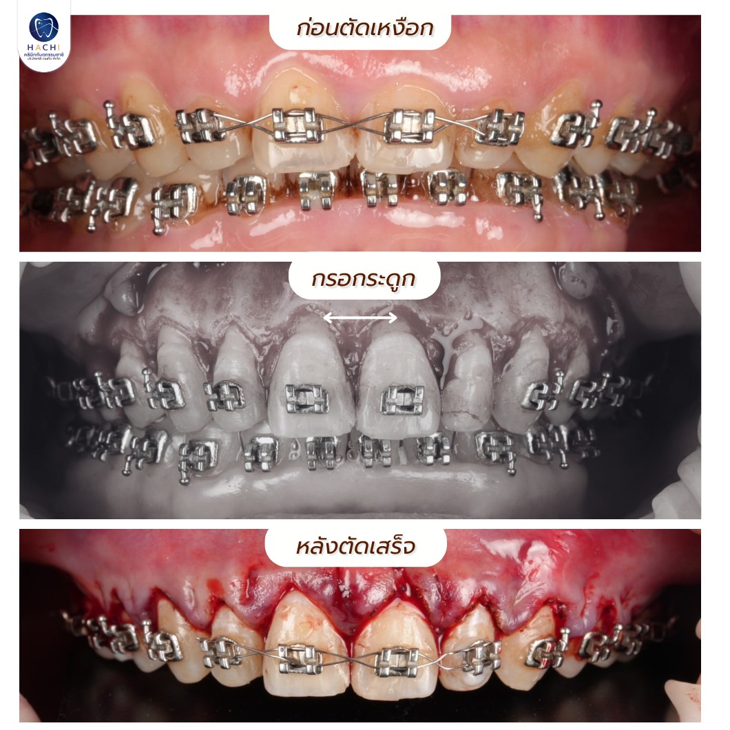 ผลงานตัดเหงือกและกรอกระดูก Hachi Dental