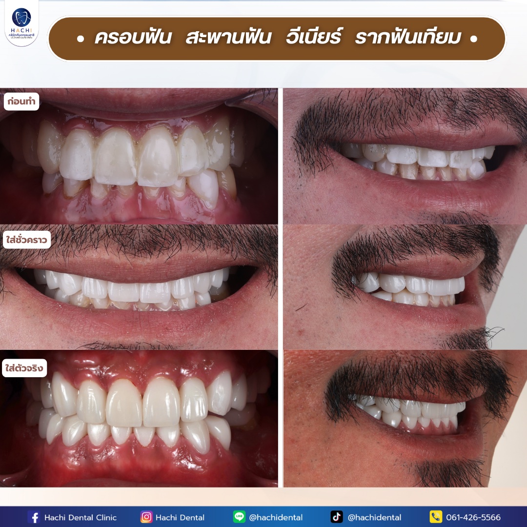รีวิวรากฟันเทียม Hachi Dental ภาพ 10
