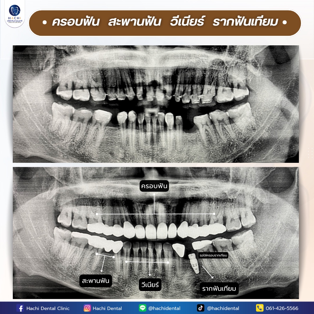 รีวิวรากฟันเทียม Hachi Dental ภาพ 11