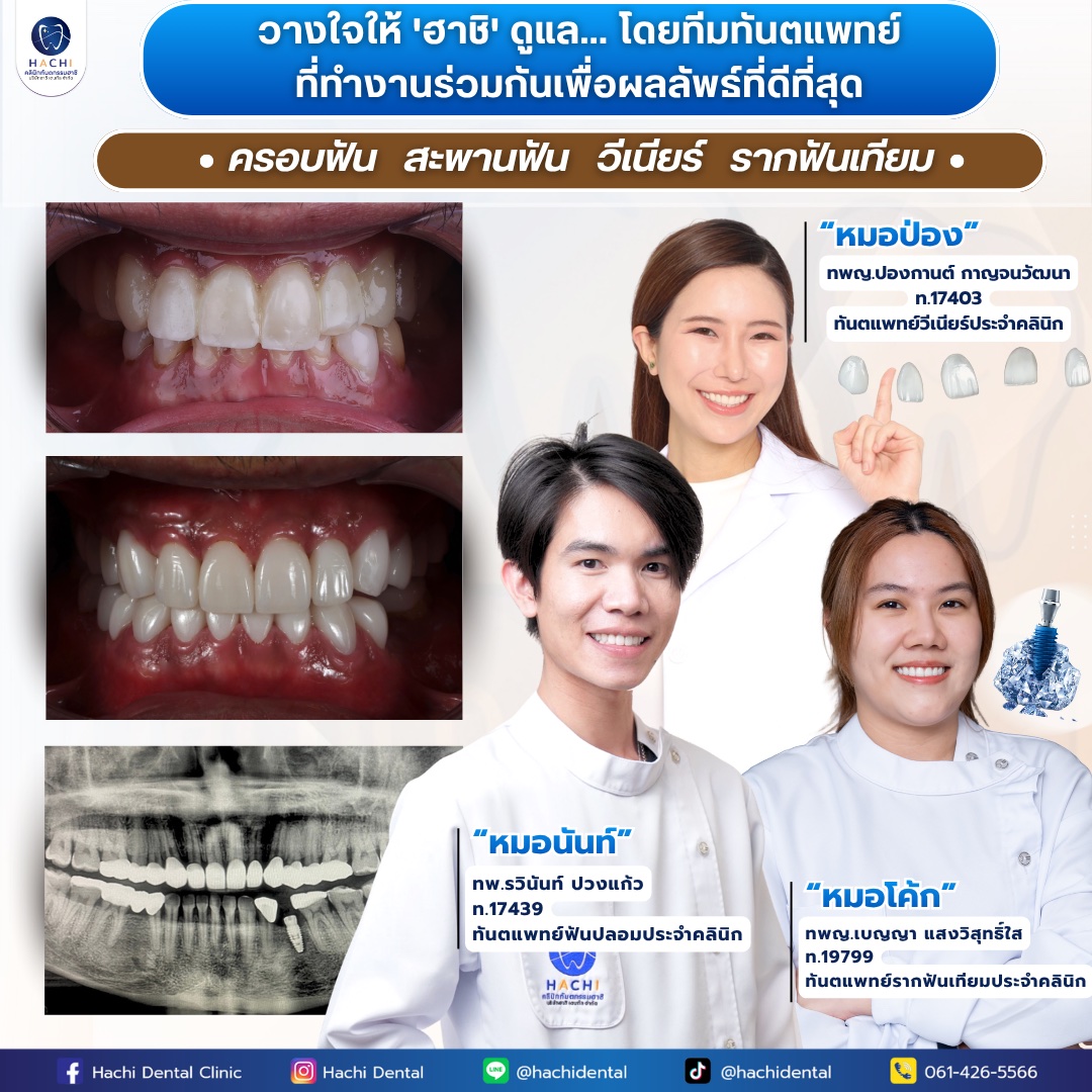 รีวิวรากฟันเทียม Hachi Dental ภาพ 12