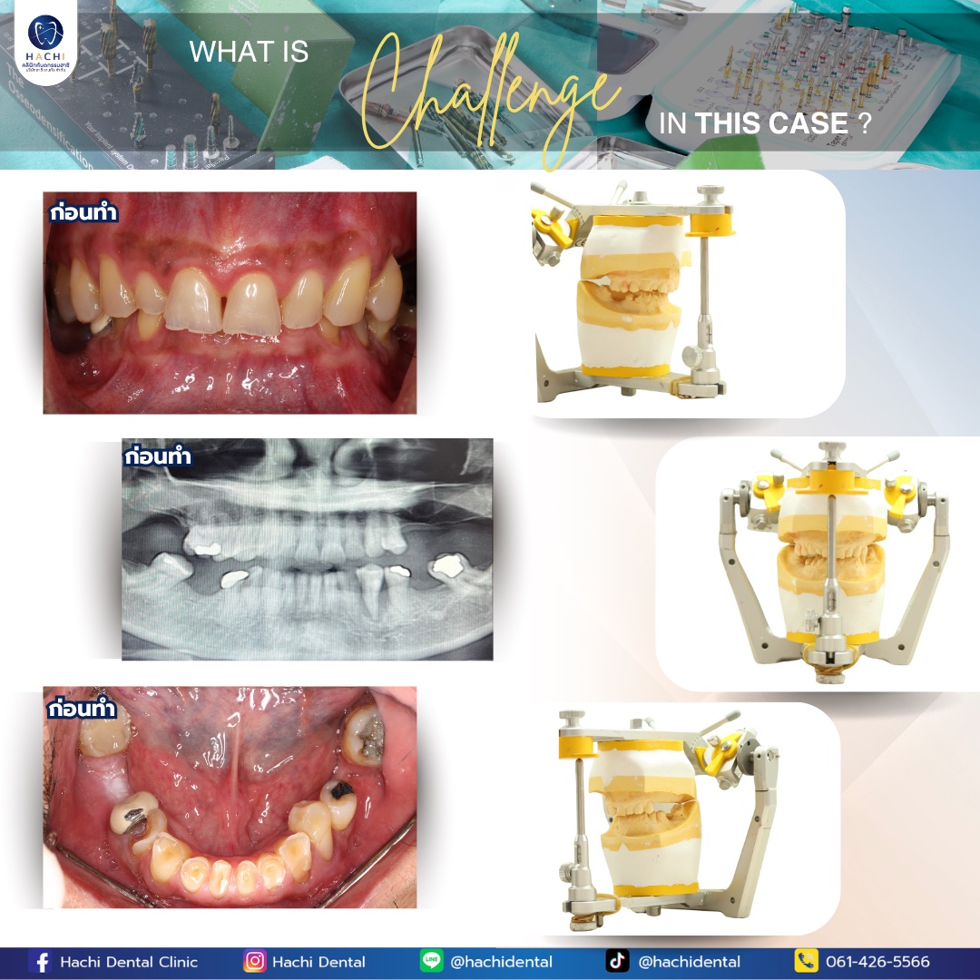 รีวิวรากฟันเทียม Hachi Dental ภาพ 16