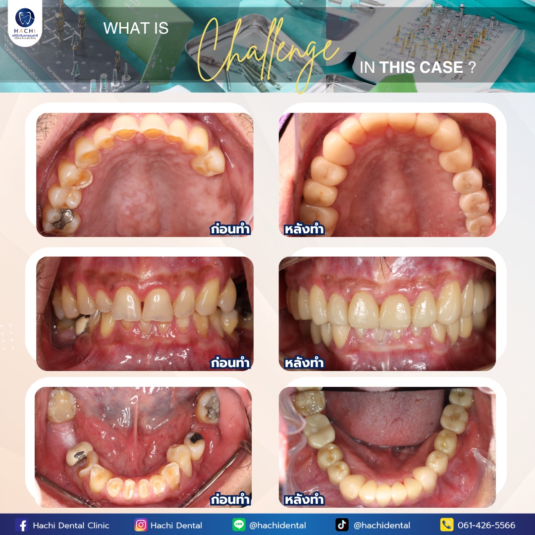 รีวิวรากฟันเทียม Hachi Dental ภาพ 18