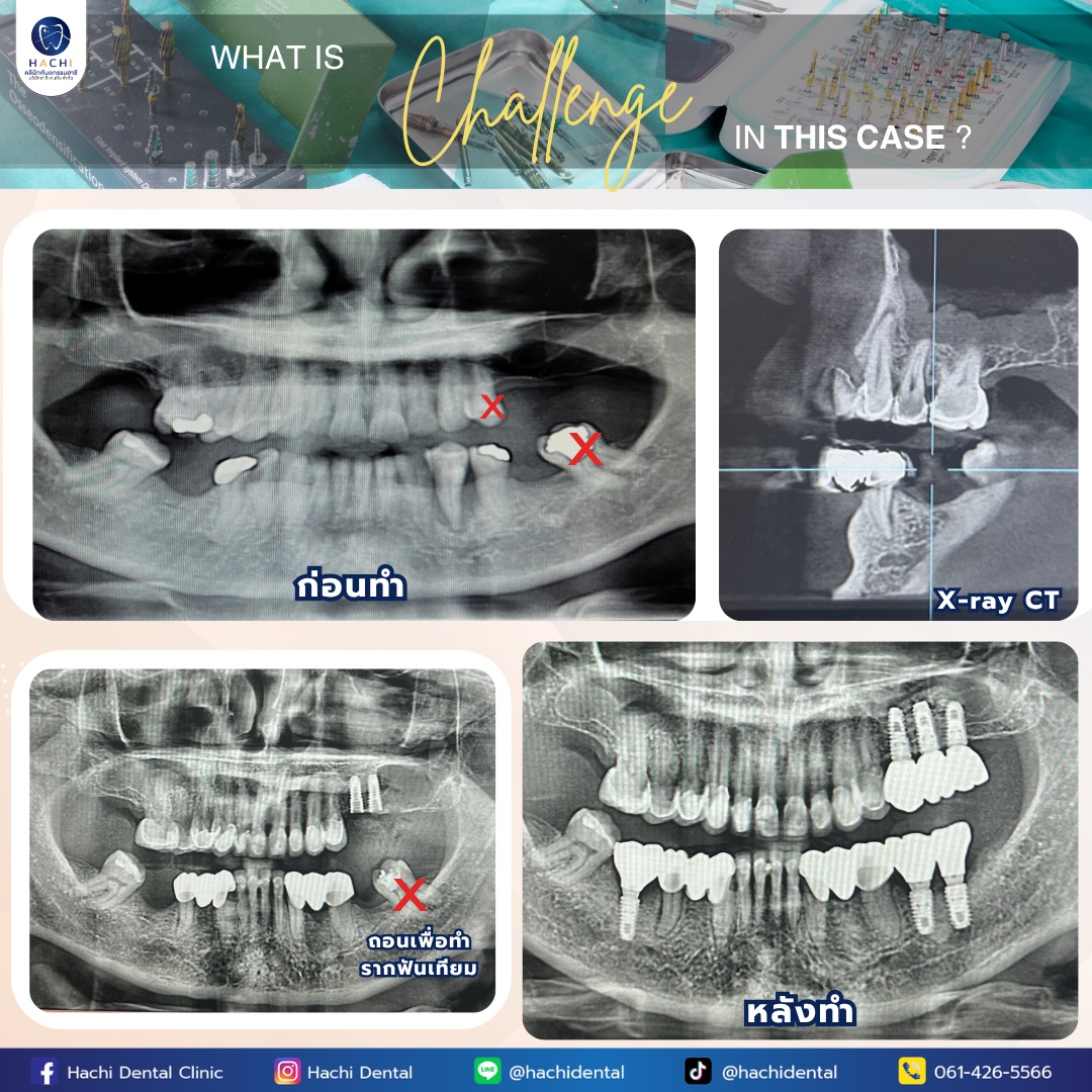 รีวิวรากฟันเทียม Hachi Dental ภาพ 19