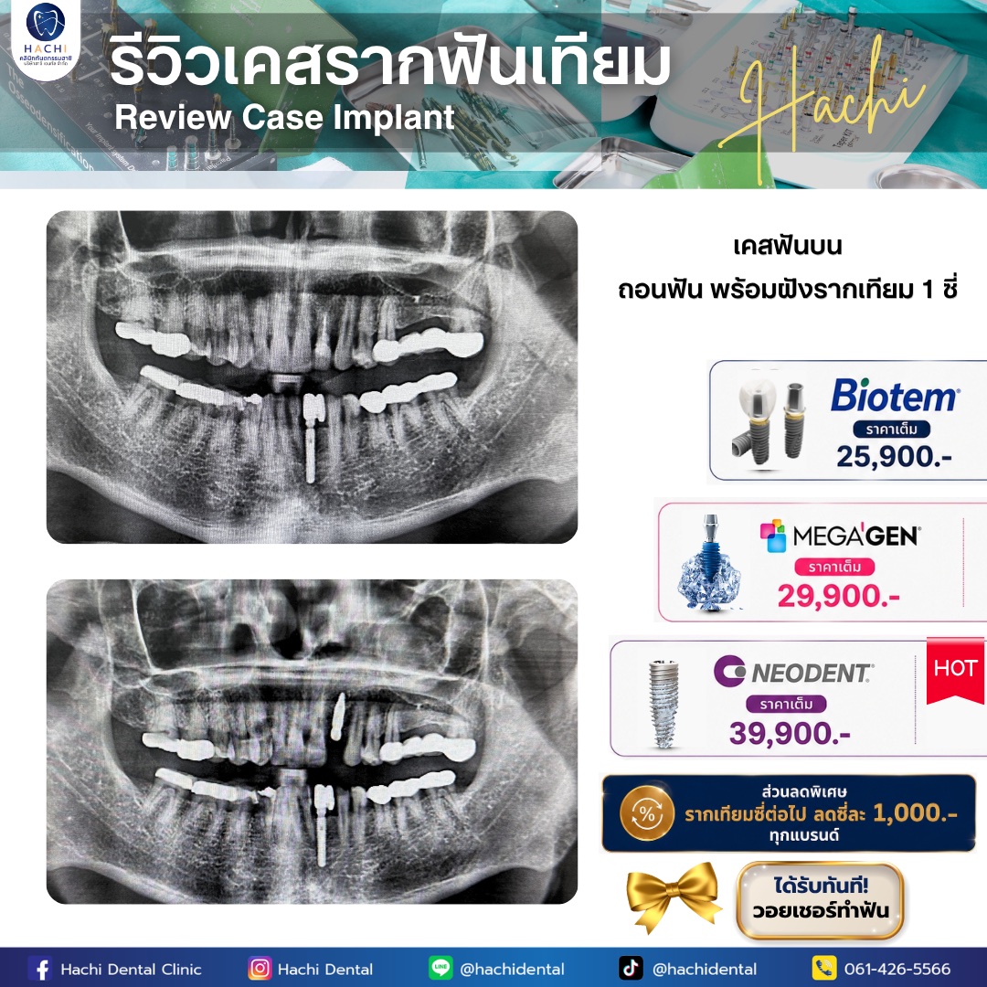 รีวิวรากฟันเทียม Hachi Dental ภาพ 22