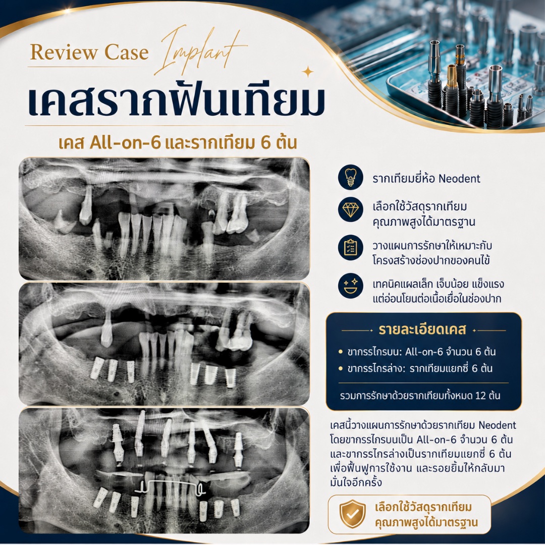 รีวิวรากฟันเทียม Hachi Dental ภาพ 29
