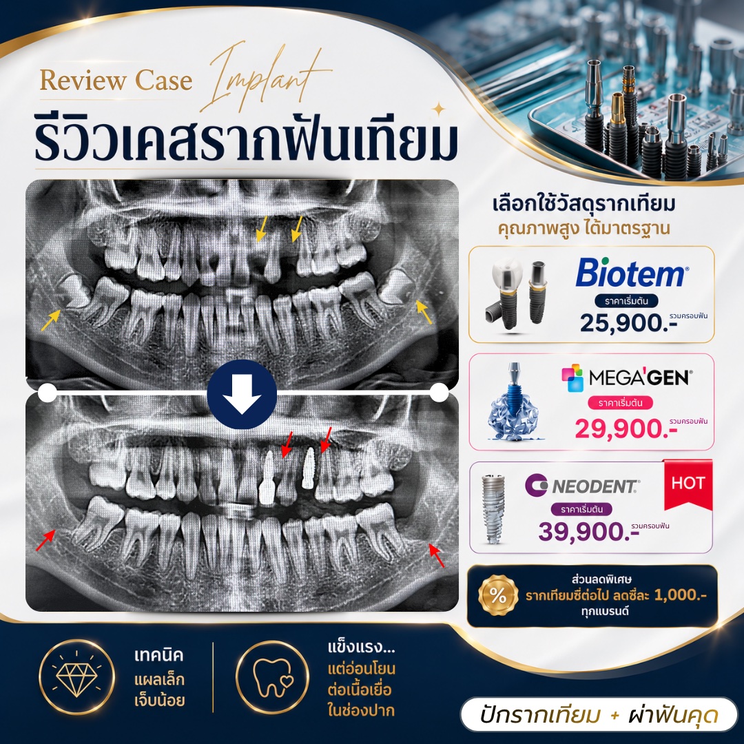 รีวิวรากฟันเทียม Hachi Dental ภาพ 30