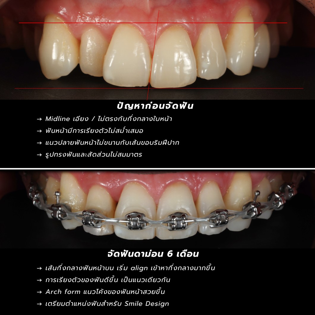 ผลงานจัดฟัน Hachi Dental ภาพที่ 13