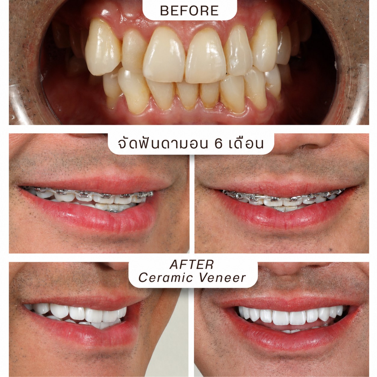 ผลงานจัดฟัน Hachi Dental ภาพที่ 24