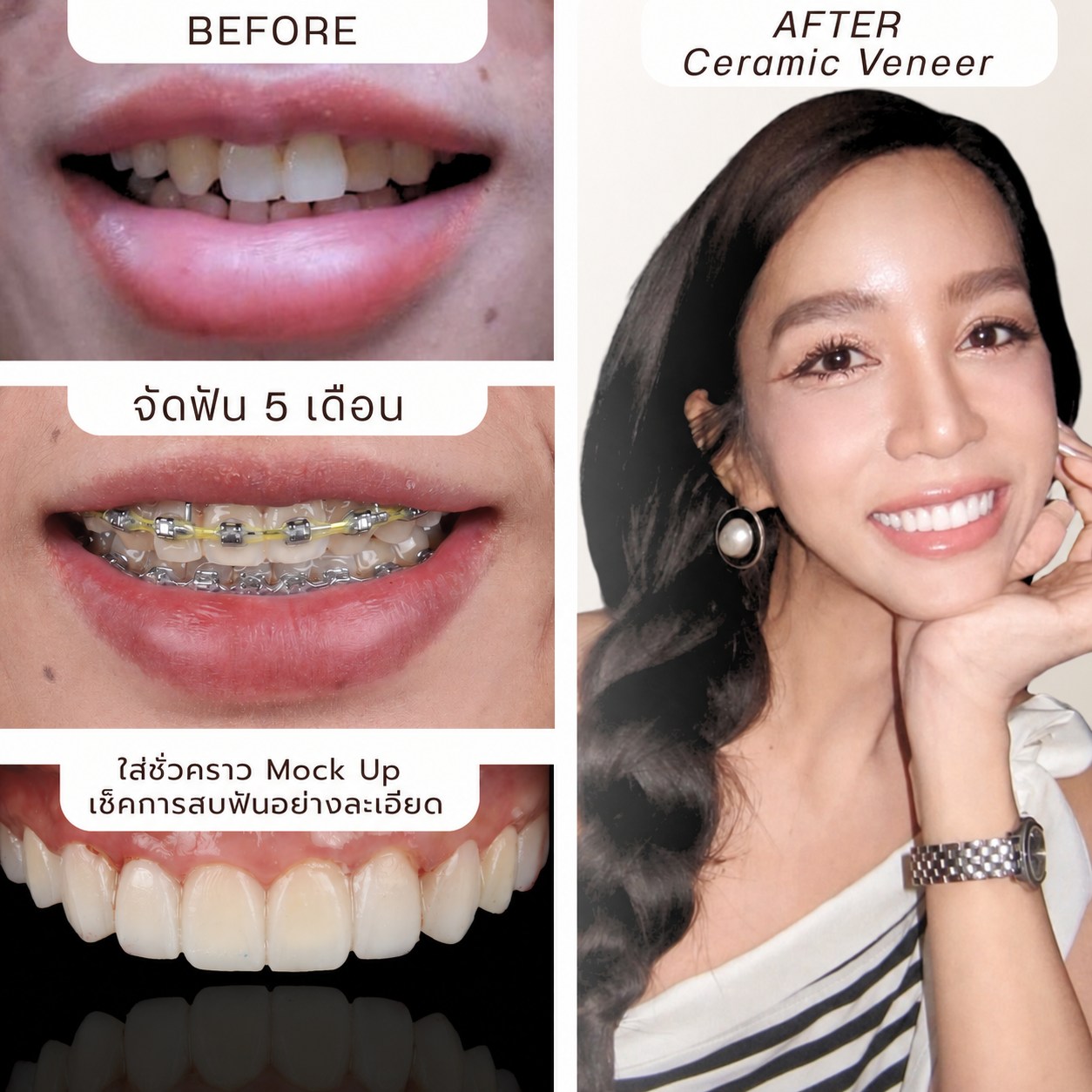ผลงานจัดฟัน Hachi Dental ภาพที่ 25