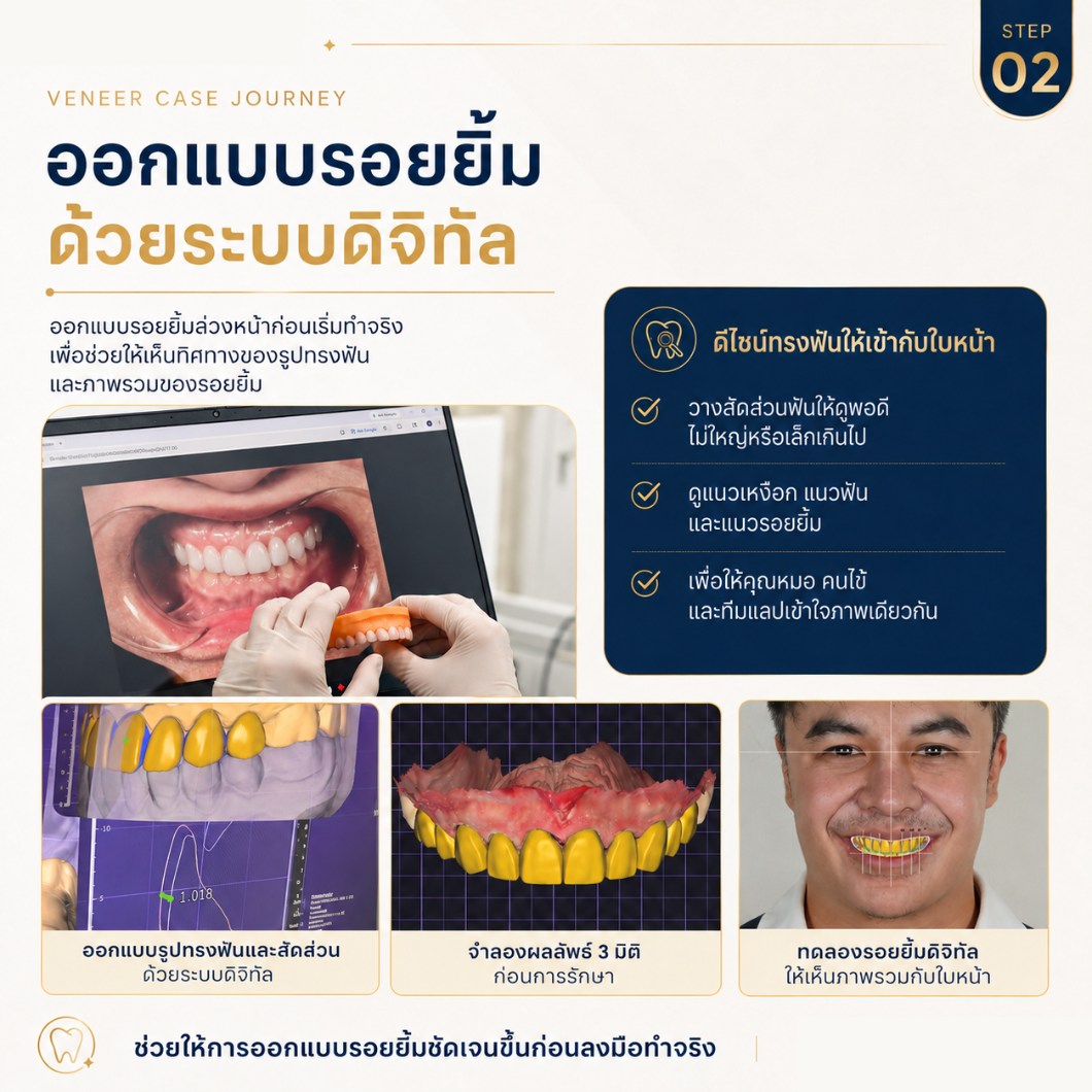 ขั้นตอนการทำวีเนียร์ ขั้นตอนที่ 2 ออกแบบรอยยิ้มด้วยระบบดิจิทัล