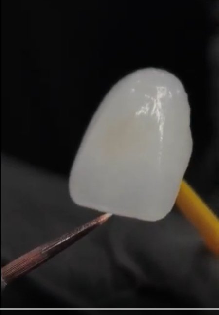 Veneer Single Closeup