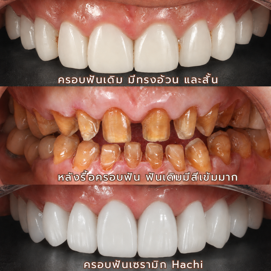 รีวิวครอบฟันเซรามิก ก่อนและหลังทำ Hachi Dental