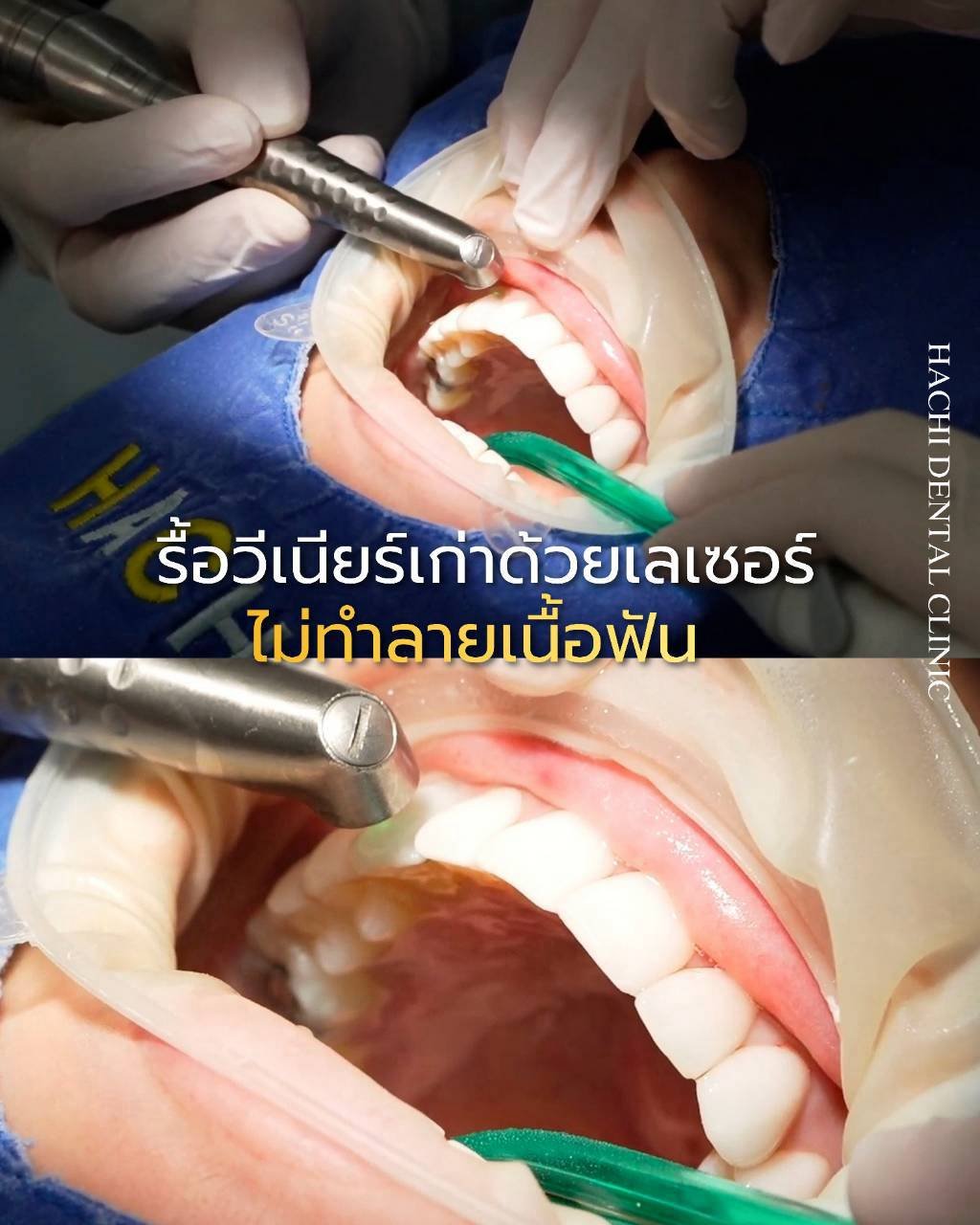 ขั้นตอนรื้อวีเนียร์เก่าด้วยเลเซอร์ ไม่ทำลายเนื้อฟัน
