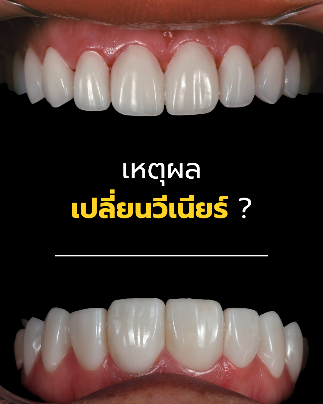 เหตุผลที่ควรพิจารณาเปลี่ยนวีเนียร์เดิม
