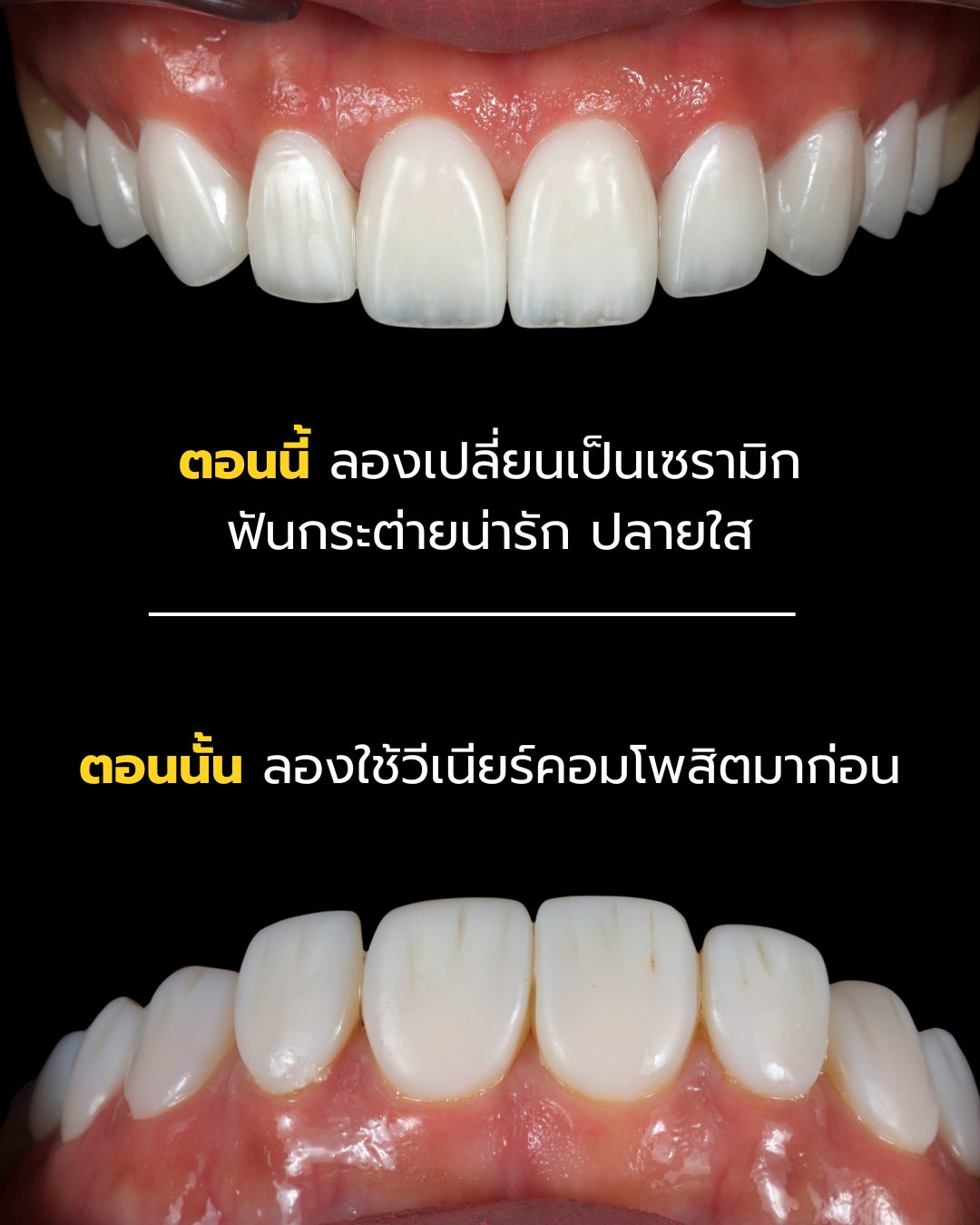 เปลี่ยนจากวีเนียร์คอมโพสิตเป็นเซรามิกทรงฟันกระต่ายปลายใส