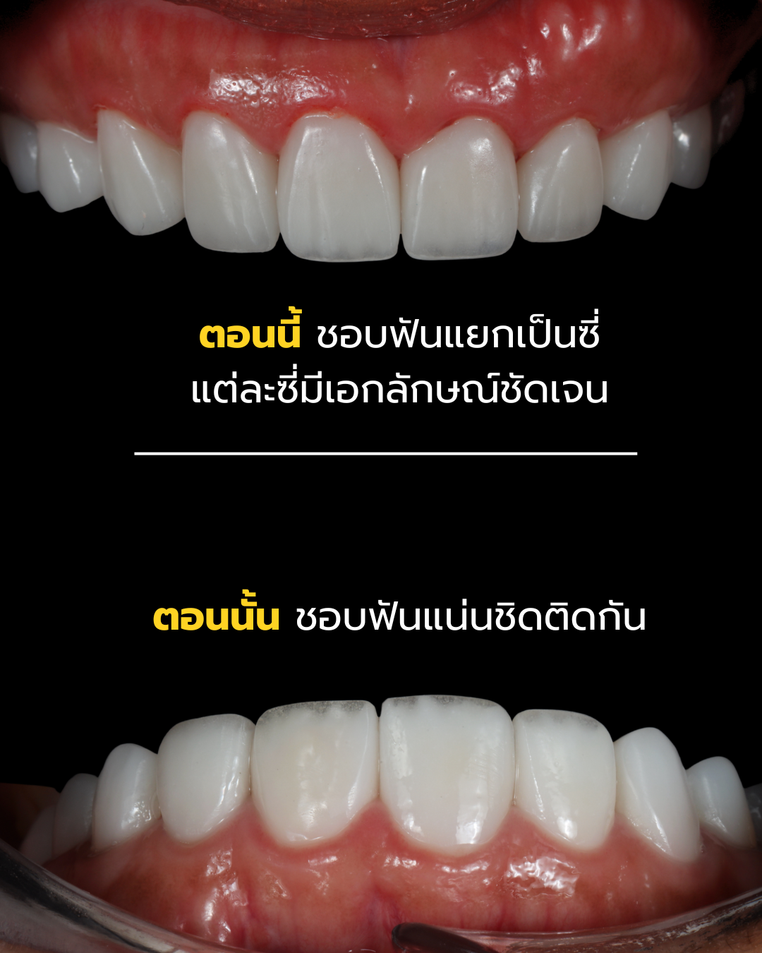 ปรับฟันจากแน่นชิดติดกันเป็นแยกซี่มีเอกลักษณ์ชัดเจน