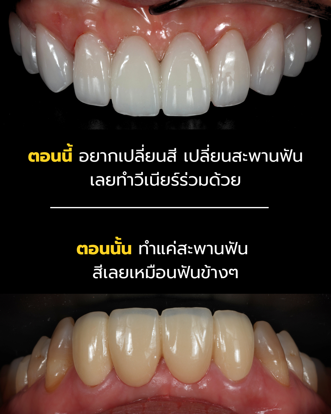 เปลี่ยนสีและทำวีเนียร์ร่วมกับสะพานฟันใหม่