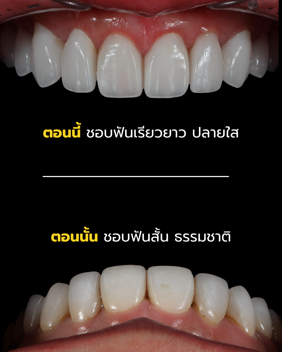 ปรับรูปฟันจากสั้นธรรมชาติเป็นทรงเรียวยาวปลายใส