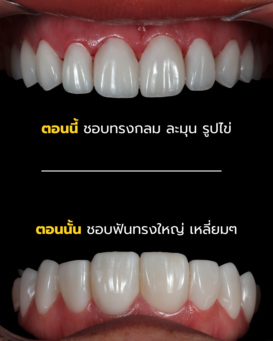 ปรับทรงฟันจากเหลี่ยมใหญ่เป็นทรงกลมรูปไข่ละมุน